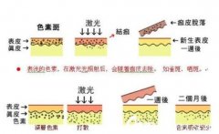 光子嫩肤适合多大年龄? width=