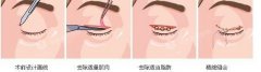 汕头割双眼皮价格大概多少钱? width=