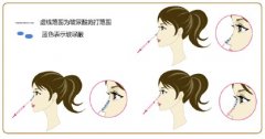 双美胶原蛋白隆鼻价格大概多少? width=