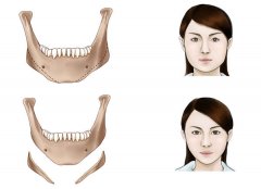 下颌角磨骨术后多久恢复自然? width=