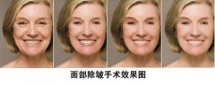 像束激光除皱的果真的很好嘛? width=