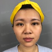 方跃明医生注射除皱技术如何?真能恢复年轻貌美吗? width=
