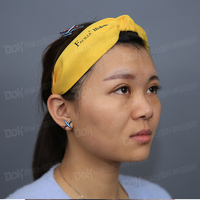 方跃明医生注射除皱技术如何?真能恢复年轻貌美吗?