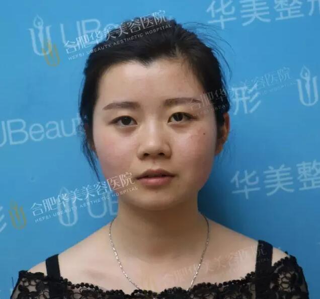 彩光换肤的果如何?真能去除我这难缠红血丝吗?