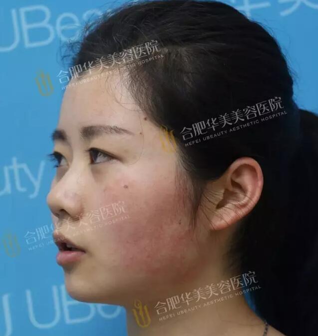 彩光换肤的果如何?真能去除我这难缠红血丝吗?