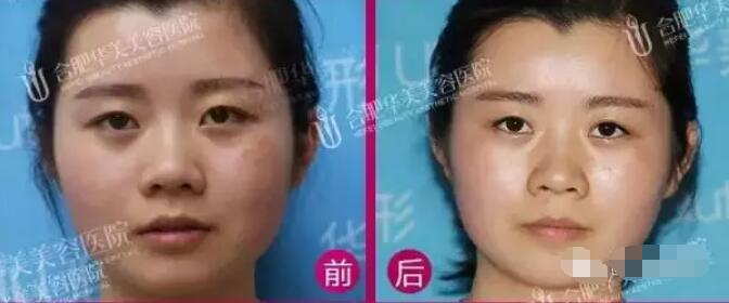 彩光换肤的果如何?真能去除我这难缠红血丝吗?