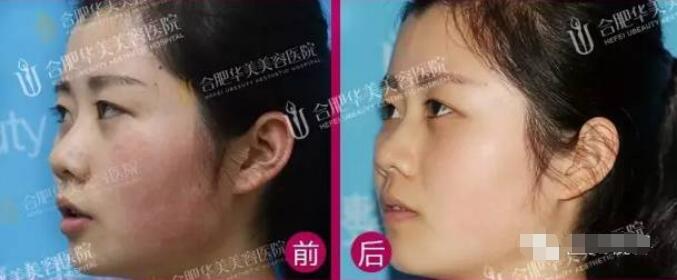 彩光换肤的果如何?真能去除我这难缠红血丝吗?