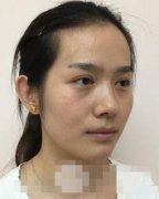重庆美白价格：美白美白案例恢复对比 width=