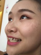 【袁志杰牙齿矫正案例】243天牙齿惊人对比图 width=