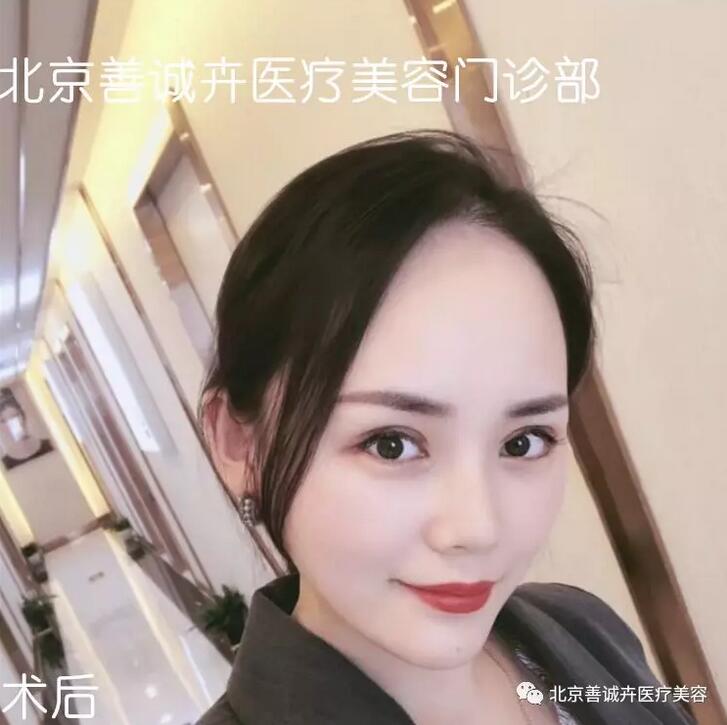 张维娜院长案例分享|SCH克隆骨隆鼻+下巴一起做，等于换一张脸？