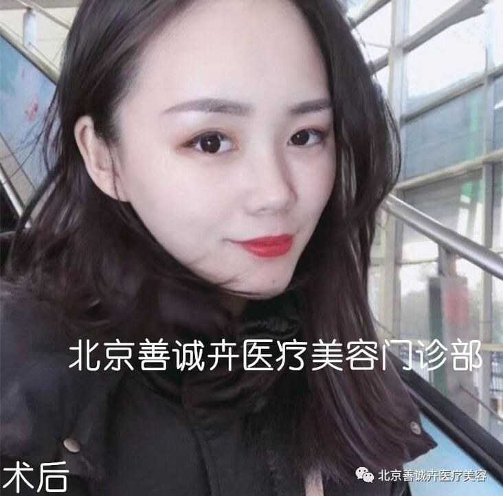 张维娜院长案例分享|SCH克隆骨隆鼻+下巴一起做，等于换一张脸？