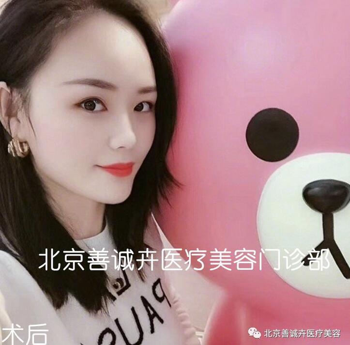 张维娜院长案例分享|SCH克隆骨隆鼻+下巴一起做，等于换一张脸？