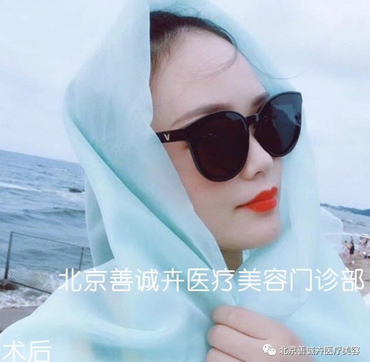 张维娜院长案例分享|SCH克隆骨隆鼻+下巴一起做，等于换一张脸？