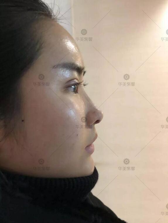 双眼皮宽度6mm好看吗？这个小姐姐用经历告诉你！