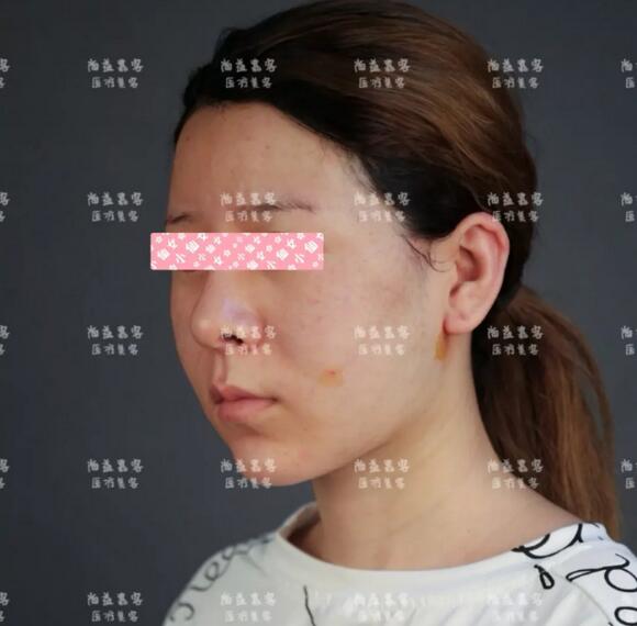 面部吸脂果图|比磨骨还要神奇的瘦脸秘籍！