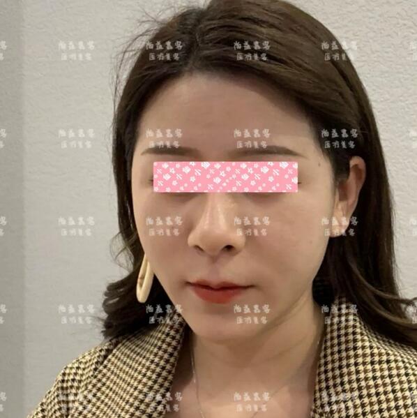 面部吸脂果图|比磨骨还要神奇的瘦脸秘籍！