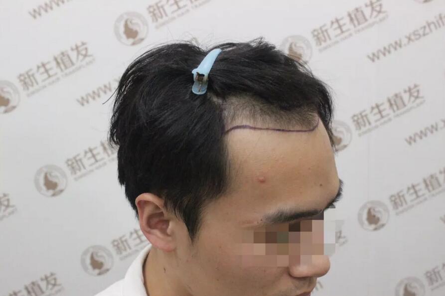 南昌宏昌植发医院怎么样？南昌宏昌植发医院案例一则~