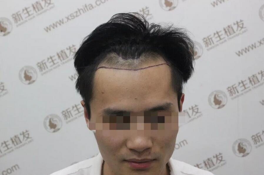 南昌宏昌植发医院怎么样？南昌宏昌植发医院案例一则~