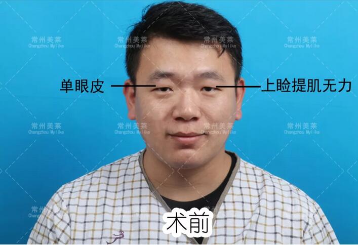 上睑下垂矫治术+开内眼角真实案例一则， 还不过来围观？！