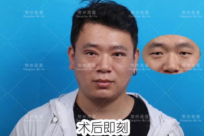 上睑下垂矫治术+开内眼角真实案例一则， 还不过来围观？！
