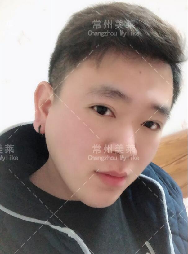 上睑下垂矫治术+开内眼角真实案例一则， 还不过来围观？！