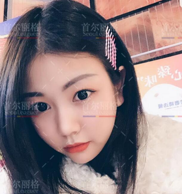 崔荣达下颌角接骨整形技术+磨颧骨+上颌后缩矫正全程记录~