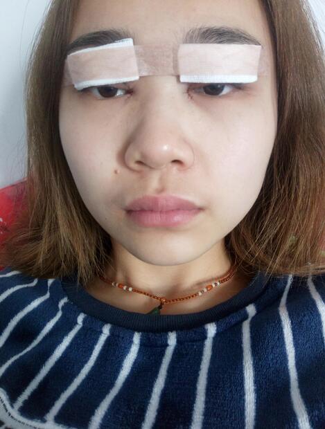 杭州格莱美整容医院汪云锋割双眼皮贵不贵？先来看看这案例~
