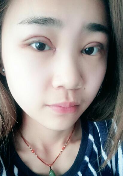 杭州格莱美整容医院汪云锋割双眼皮贵不贵？先来看看这案例~