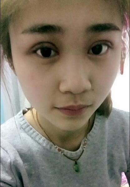 杭州格莱美整容医院汪云锋割双眼皮贵不贵？先来看看这案例~