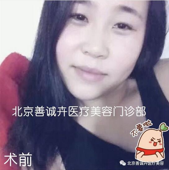 善诚卉张维娜做克隆隆鼻