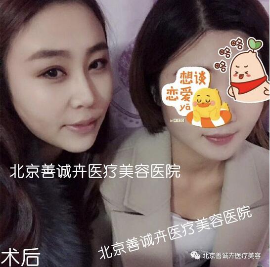 善诚卉张维娜做克隆隆鼻