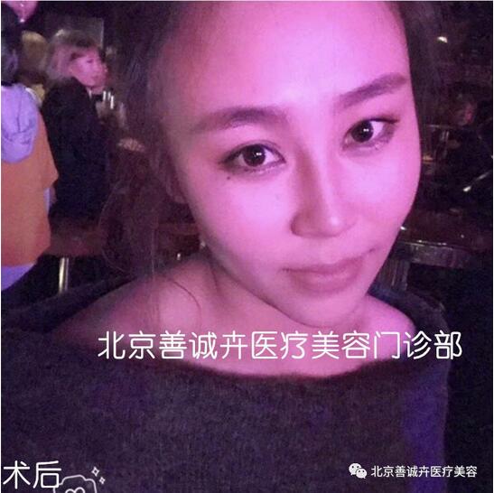 善诚卉张维娜做克隆隆鼻