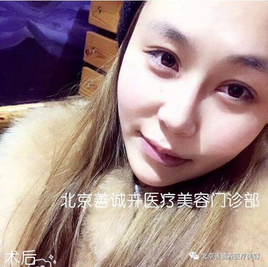 善诚卉张维娜做克隆隆鼻