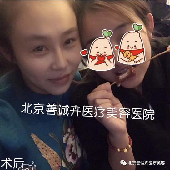 善诚卉张维娜做克隆隆鼻