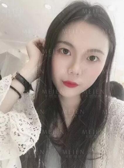 脂土味路人做自体脂肪面部填充术，颜值吊打女团成员？