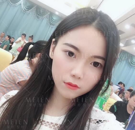 脂土味路人做自体脂肪面部填充术，颜值吊打女团成员？
