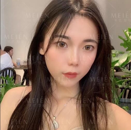脂土味路人做自体脂肪面部填充术，颜值吊打女团成员？
