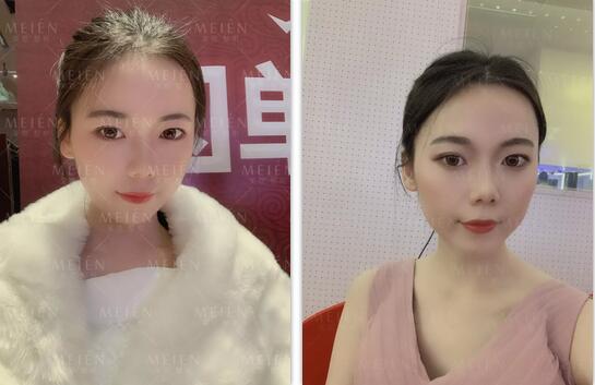 脂土味路人做自体脂肪面部填充术，颜值吊打女团成员？