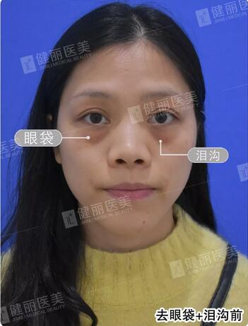 健丽光乳化去眼袋