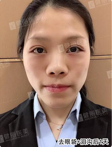 健丽光乳化去眼袋
