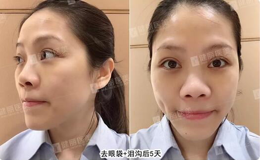 健丽光乳化去眼袋