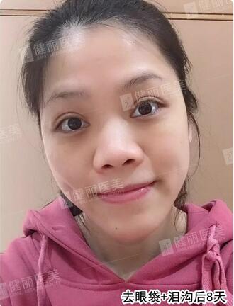 健丽光乳化去眼袋