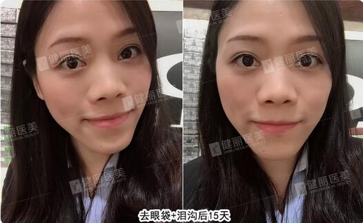 健丽光乳化去眼袋