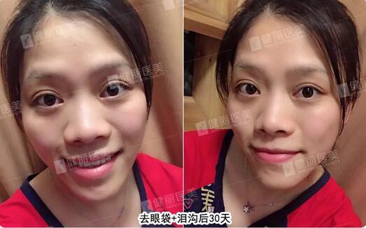 健丽光乳化去眼袋