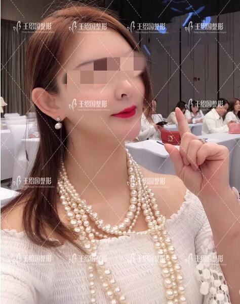 黎星下巴取出案例