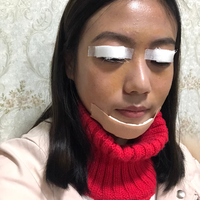 黄小闪双眼皮+垫下巴+美白案例分享~前后变化如此之大
