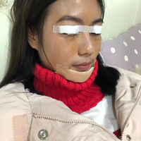 黄小闪双眼皮+垫下巴+美白案例分享~前后变化如此之大