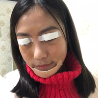 黄小闪双眼皮+垫下巴+美白案例分享~前后变化如此之大