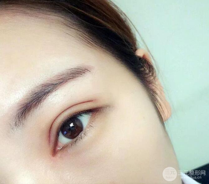 韩仕医美医院双眼皮技术如何?我想改变我这内双