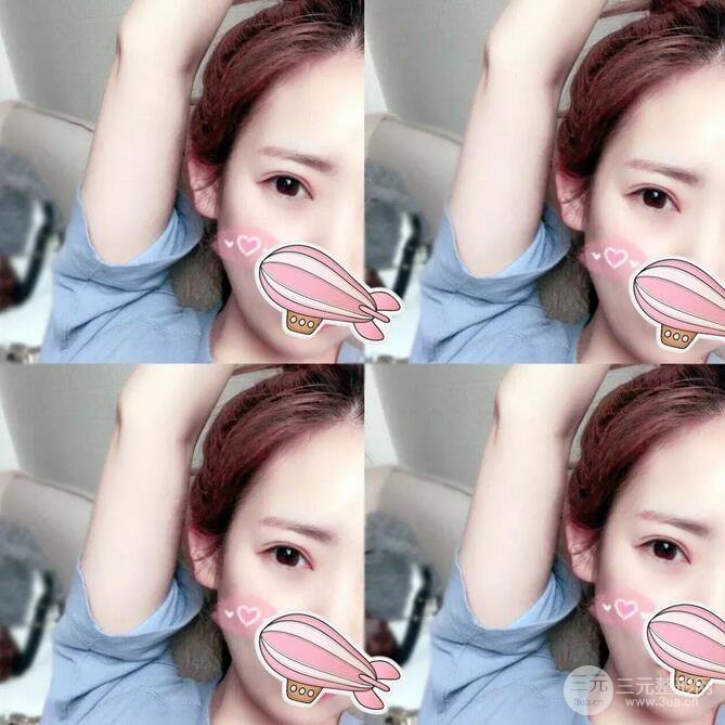 韩仕医美医院双眼皮技术如何?我想改变我这内双